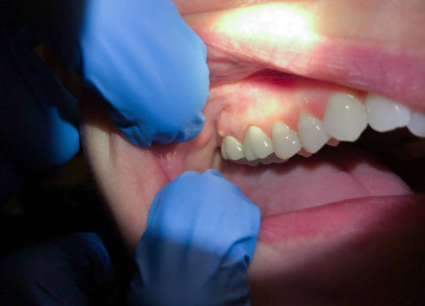 Best Emergency Wisdom Teeth Removal in Elon, NC